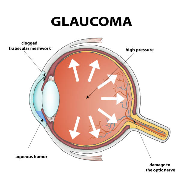 illustrations, cliparts, dessins animés et icônes de glaucoma - choroid