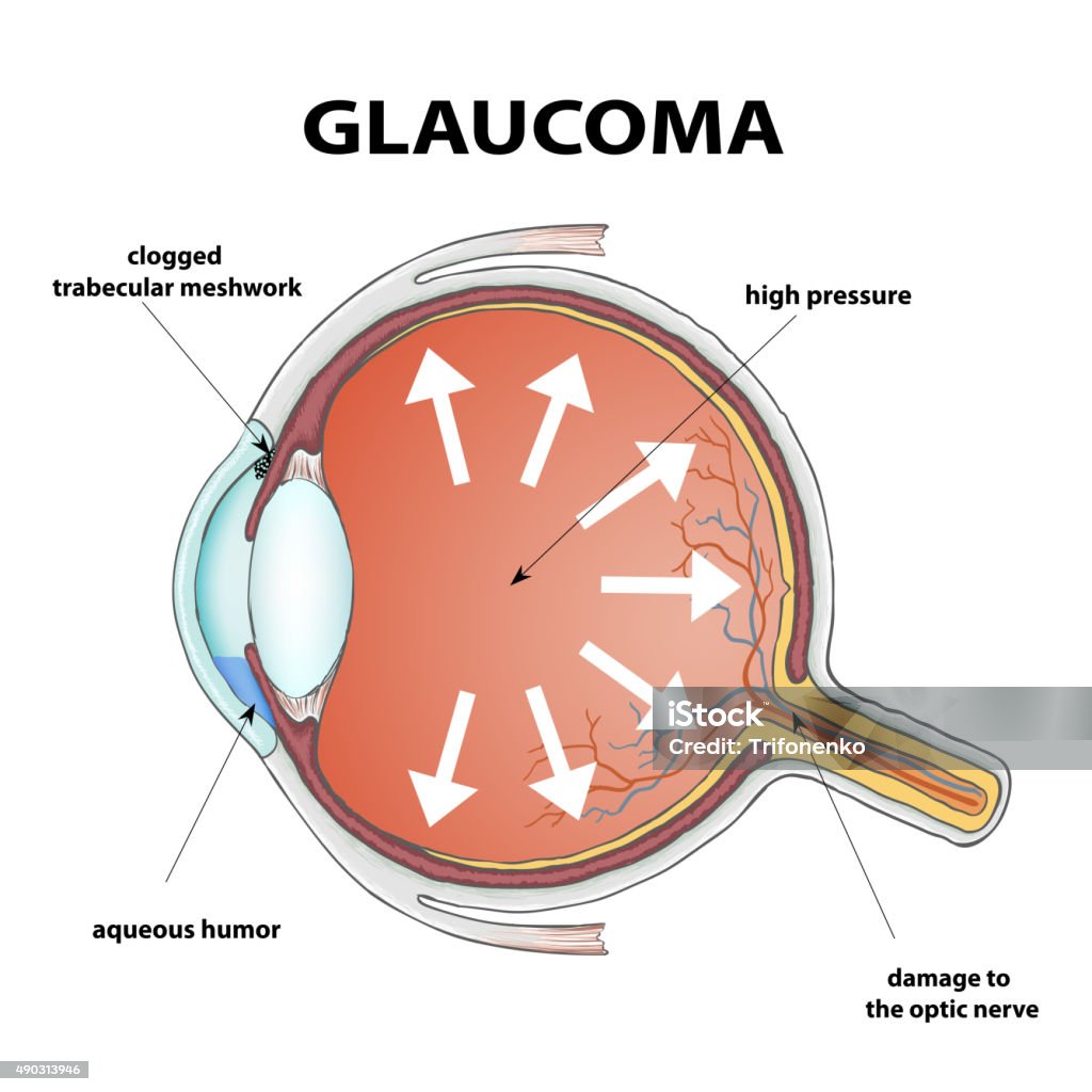 glaucoma Human eye. Disease glaucoma. Stock Vector illustration. Glaucoma stock vector
