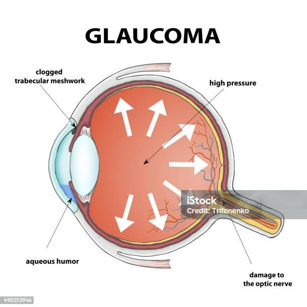 Glaucoma Stock Illustration - Download Image Now - Glaucoma, Diagram, Anxiety