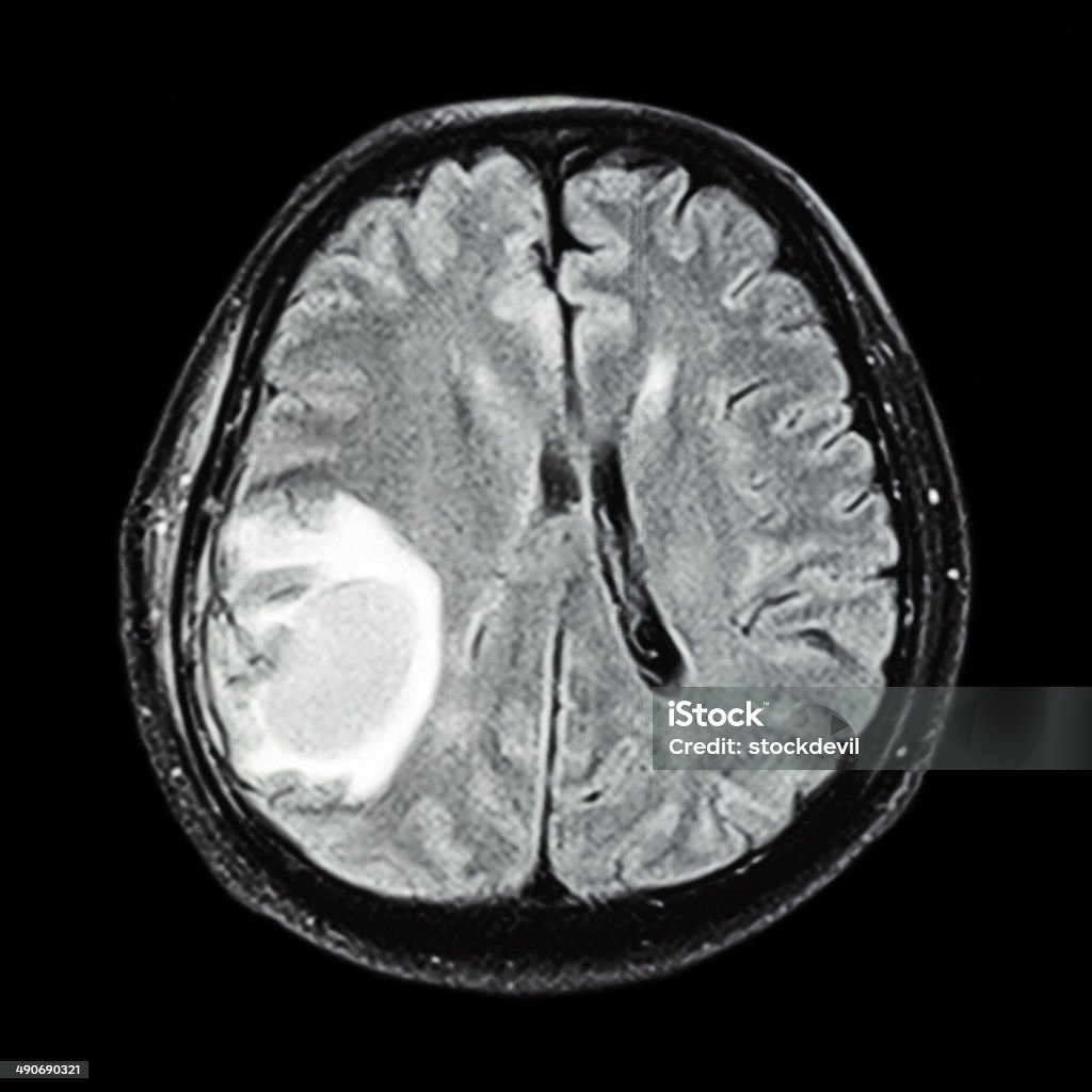 MRI spectacle bénigne au cerveau: - Photo de Tumeur métastatique libre de droits