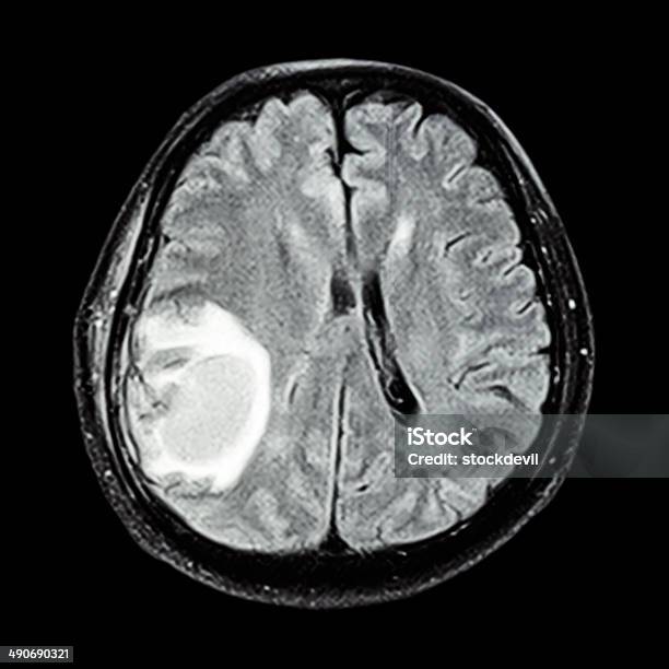 Photo libre de droit de Mri Spectacle Bénigne Au Cerveau banque d'images et plus d'images libres de droit de Tumeur métastatique - Tumeur métastatique, Image par résonance magnétique, Mesure de la masse