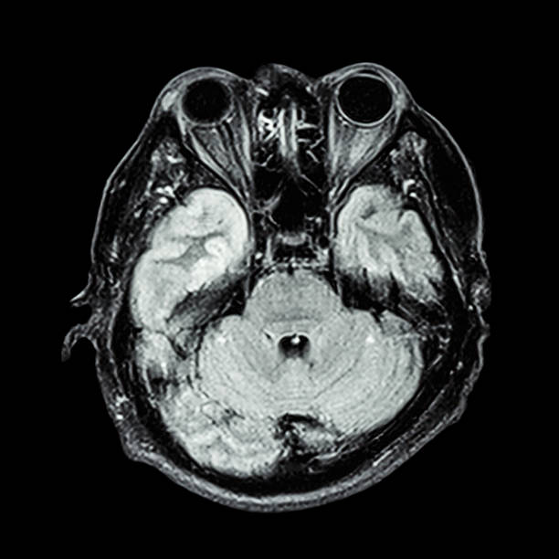 istock MRI : show lower part of brain 490690459