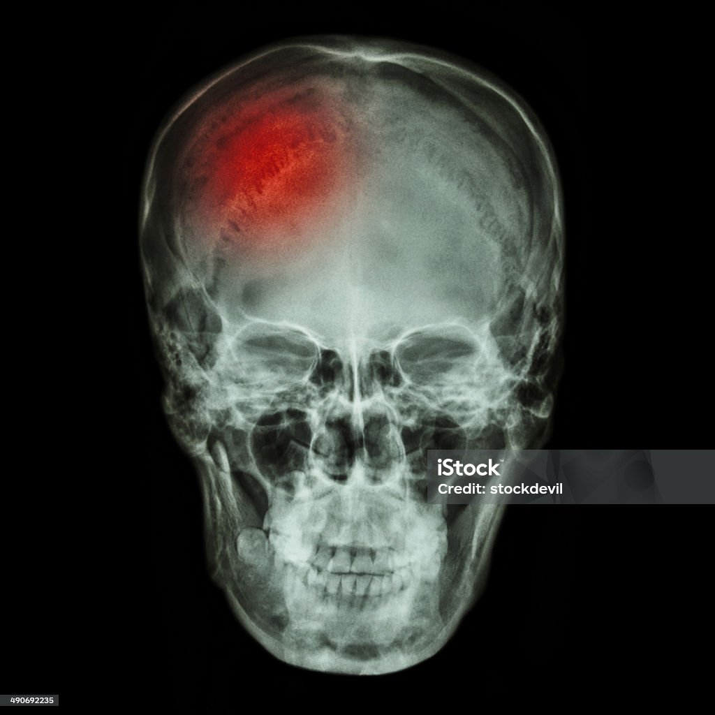 X-ray normal asian skull (Thai people) and headache Adult Stock Photo
