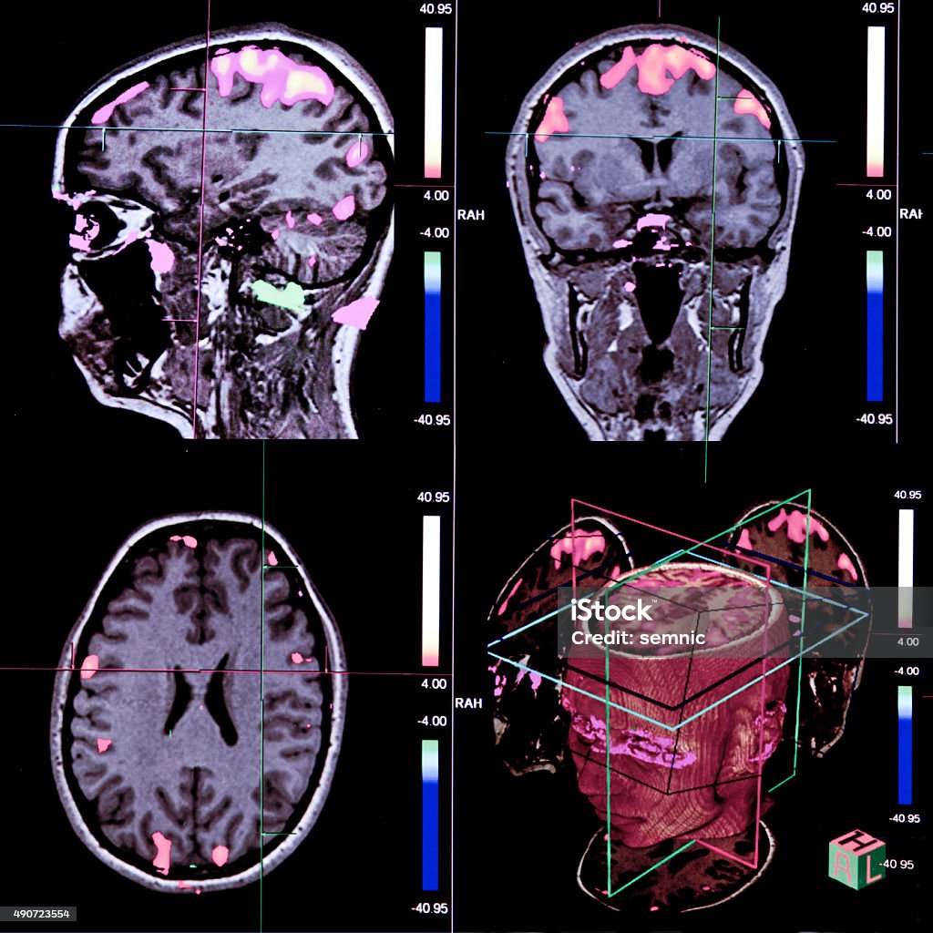 Cerveau à résonance magnétique - Photo de 2015 libre de droits