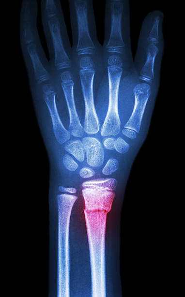 knochenbruch distale radius (unterarm-bone) - x ray x ray image human hand anatomy stock-fotos und bilder