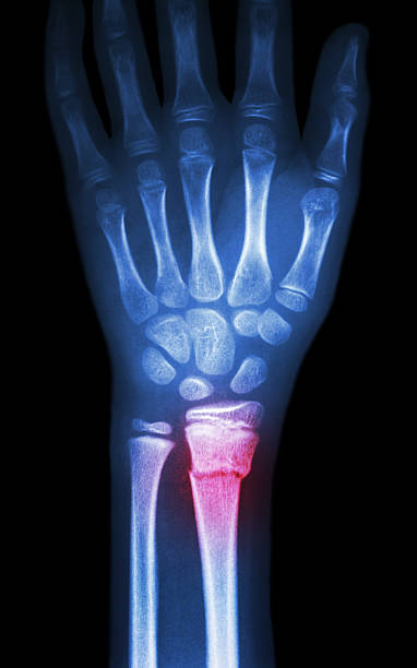 złamanie dystalnego przedramienia's promień (kości) - x ray x ray image human hand anatomy zdjęcia i obrazy z banku zdjęć