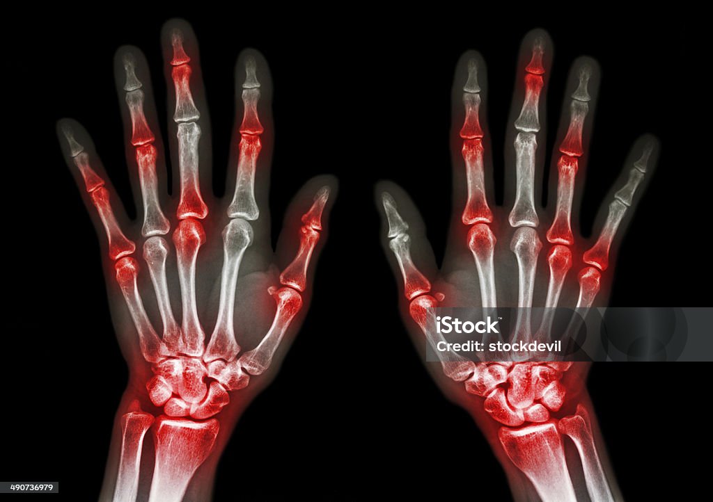 Arthrite à plusieurs articulations de la main (Gout, Rhumatisme - Photo de Imagerie par rayons x libre de droits