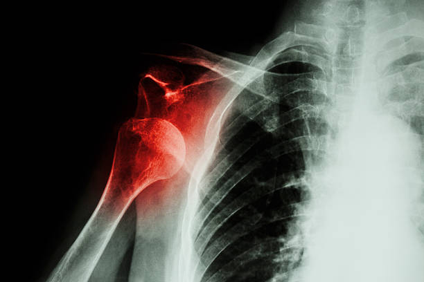 spalla anteriore a raggi x di dislocazione - shoulder bone foto e immagini stock