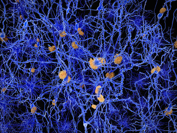 Alzheimer disease, neuron network with amyloid plaques Neurons with amyloid plaques. Amyloid plaques accumulate outside neurons. Amyloid plaques are characteristic features of Alzheimer's disease. They lead to a degeneration of the affected neurons, that are destroyed through the activity of microglia cells. The neurons are embedded in a network of astrozytes (darker cells). atrophy photos stock pictures, royalty-free photos & images