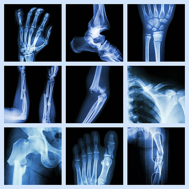 istock Collection of bone fracture 490925843
