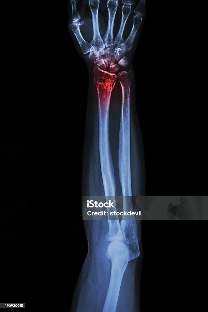 Fracture distal radius (wrist bone) ,(Colles' fracture) Bone Fracture Stock Photo