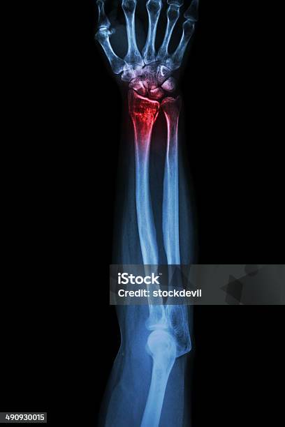 Fracture Distal Radius Stock Photo - Download Image Now