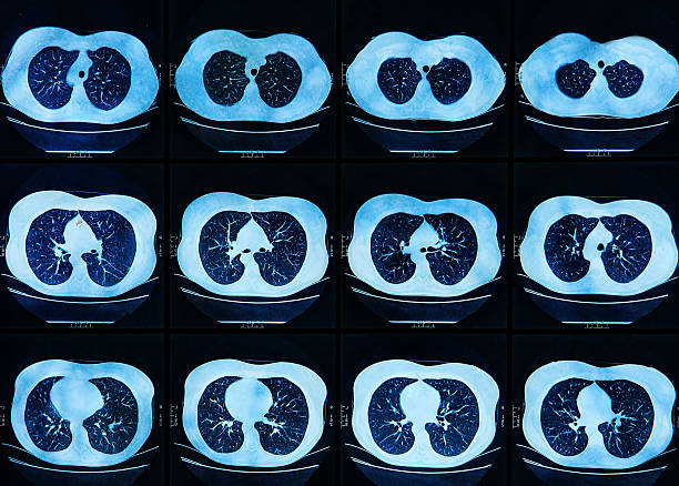 mri skanowania ludzkiego płuc - x ray chest human lung rib cage zdjęcia i obrazy z banku zdjęć