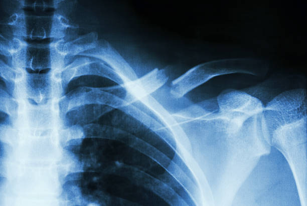 fracture left clavicle Film X-ray show complete fracture middle 1/3 left clavicle bone fracture stock pictures, royalty-free photos & images