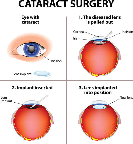 illustrations, cliparts, dessins animés et icônes de cataract chirurgie - choroid