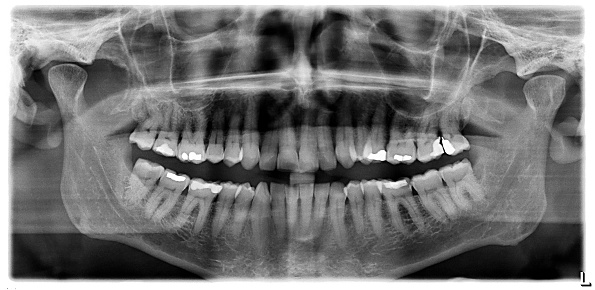 Teeth x-ray front view