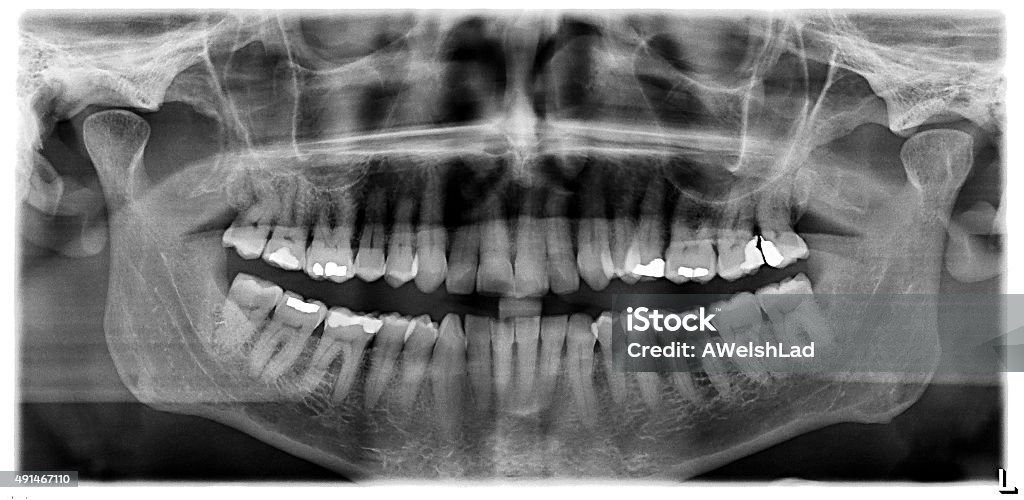 Front Tooth X Ray Teeth Xray Front View Stock Photo - Download Image Now - 2015, Data ...