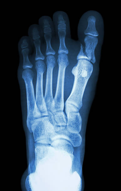 fracture proximal phalange at first toe film x-ray show fracture proximal phalange at first toe pollex stock pictures, royalty-free photos & images