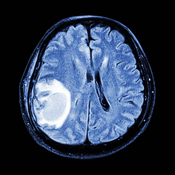 MRI brain MRI brain : show brain tumor at right parietal lobe of cerebrum brain tumour stock pictures, royalty-free photos & images