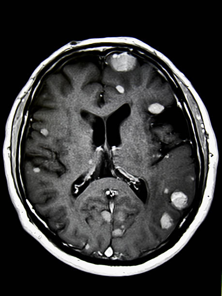 Brain tumors - MRI multiple brain tumors - metastases, on MRI metastasis photos stock pictures, royalty-free photos & images