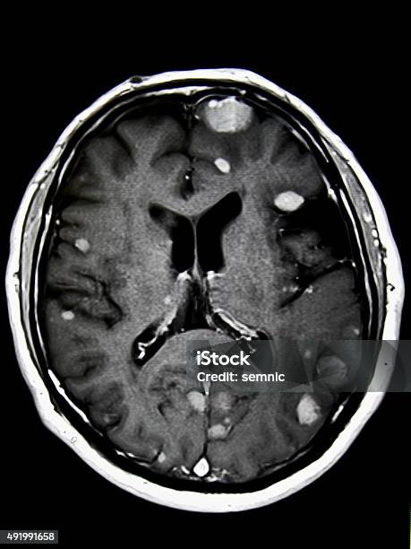 Brain Tumors Mri Stock Photo - Download Image Now - Metastasis, Human Brain, 2015