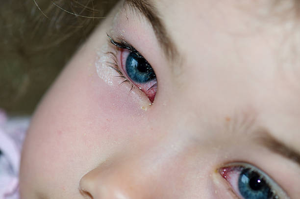 gros plan sur les yeux d'une petite fille conjonctivite - conjunctivitis sore eyes child human eye photos et images de collection