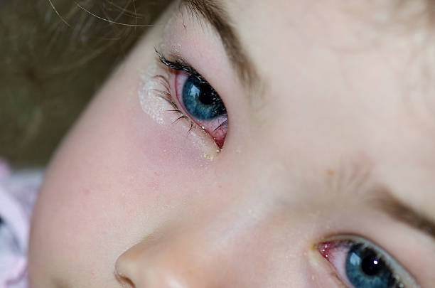 건반에서 클로즈업 소녀만 왜고너의 아이즈 갖는 결막염 - conjunctivitis sore eyes child human eye 뉴스 사진 이미지
