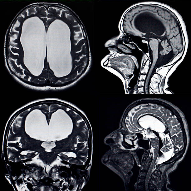 Hydrocephalus - brain MRI Dilated ventricles of the brain, MRI hydrocephalus photos stock pictures, royalty-free photos & images