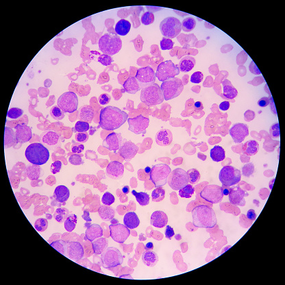 Blood smear of leukemia patient under microscope