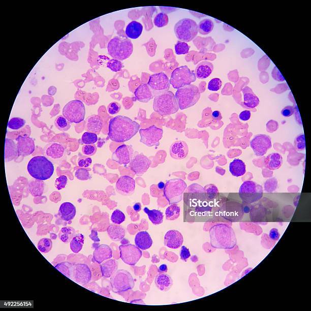 Blood Smear Of Leukemia Patient Under Microscope Stock Photo - Download Image Now - Microscope, Leukemia, Chronic Granulocytic Leukemia