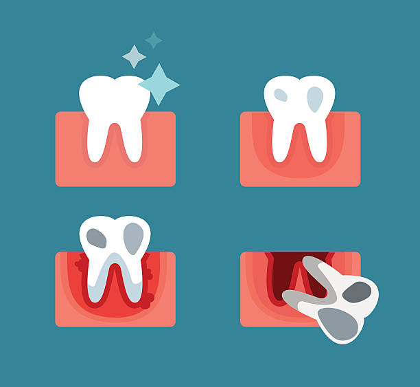 zapalenie przyzębia etapie kroki ilustracja wektorowa - human teeth gums dental hygiene inflammation stock illustrations