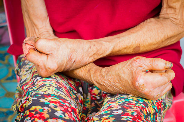 closeup hands of old woman suffering from leprosy Closeup hands of old woman suffering from leprosy. mycobacterium leprae stock pictures, royalty-free photos & images