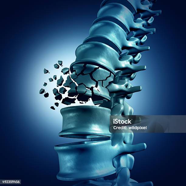 Fractura De Columna Vertebral Foto de stock y más banco de imágenes de Osteoporosis - Osteoporosis, Fractura, Vértebra humana