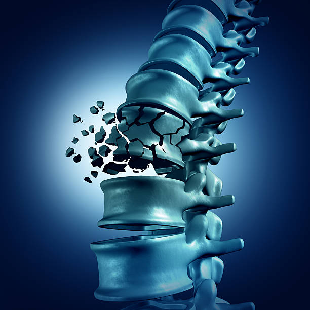fractura vertebral - human vertebra fotos imagens e fotografias de stock