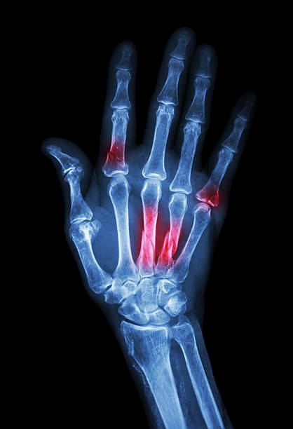 istock Multiple fracture at index,little finger,metacarpal bone 492595985