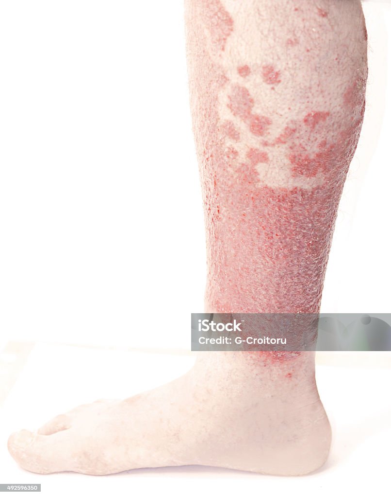 Les jambes enflées avec le psoriasis - Photo de Psoriasis libre de droits
