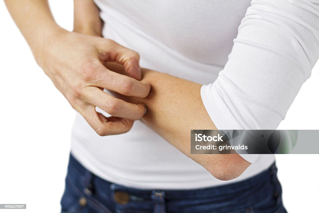 Frau mit Symptome eczema - Lizenzfrei Dermatitis Stock-Foto