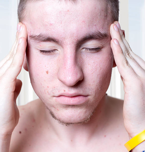istock Problems with acnes on the teenager skin 492779122