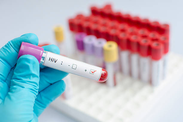 HIV blood sample Blood sample positive with HIV aids stock pictures, royalty-free photos & images