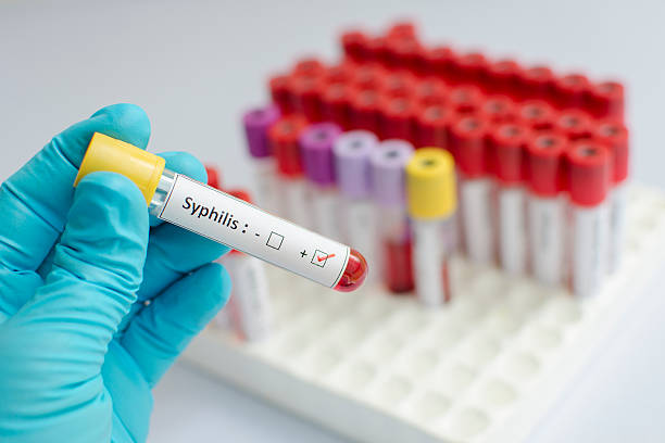Syphilis blood sample Blood sample with syphilis (Treponema Pallidum) positive sti stock pictures, royalty-free photos & images