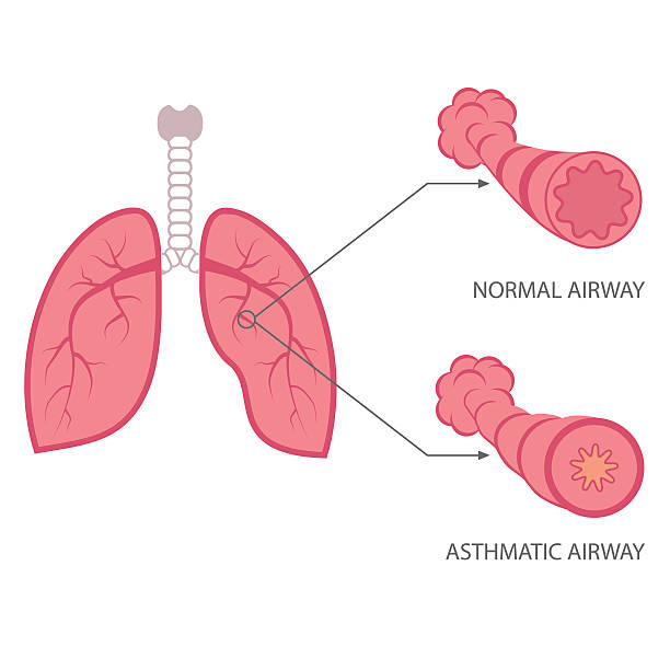 asthma vector asthma illustration, bronchial, lungs respiratory disease, bronchitis stock illustrations