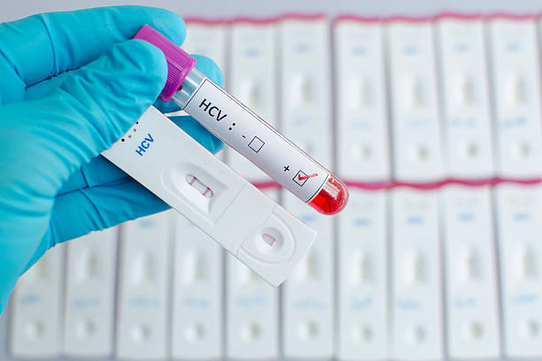 Hepatitis C virus (HCV) testing positive stock photo