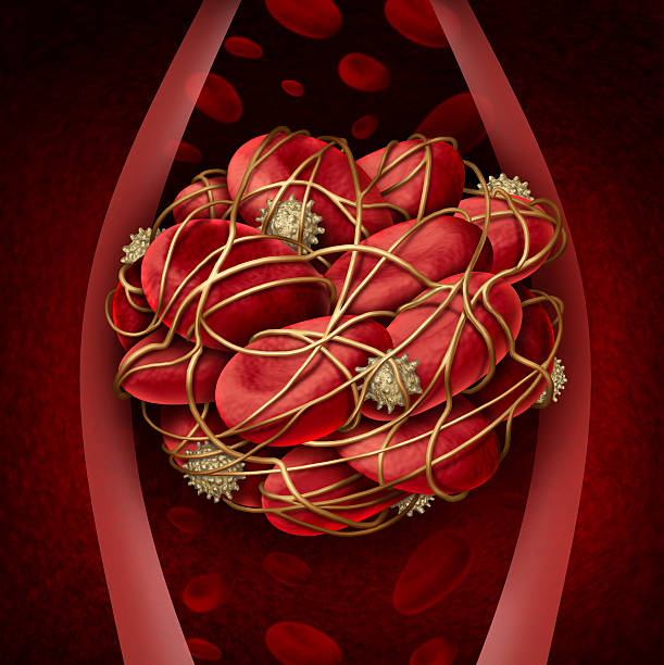 Blood Clot Blood clot and thrombosis medical illustration concept as a group of human blood cells clumped together by sticky platelets and fibrin creating a blockage in an artery or vein as a health disorder symbol for circulatory system danger. blood clot photos stock pictures, royalty-free photos & images