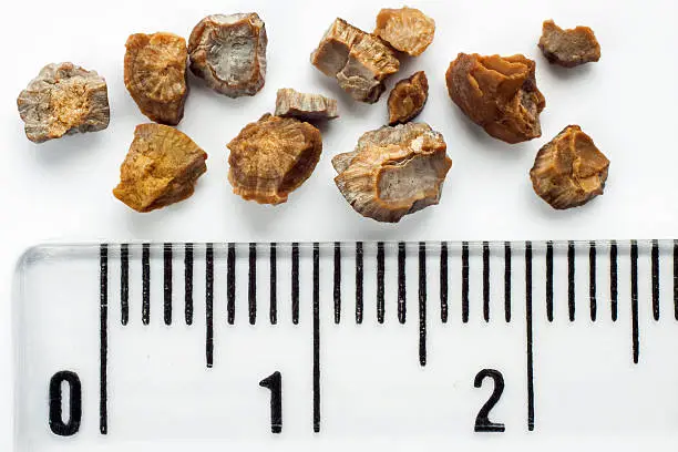 Photo of Kidney stones