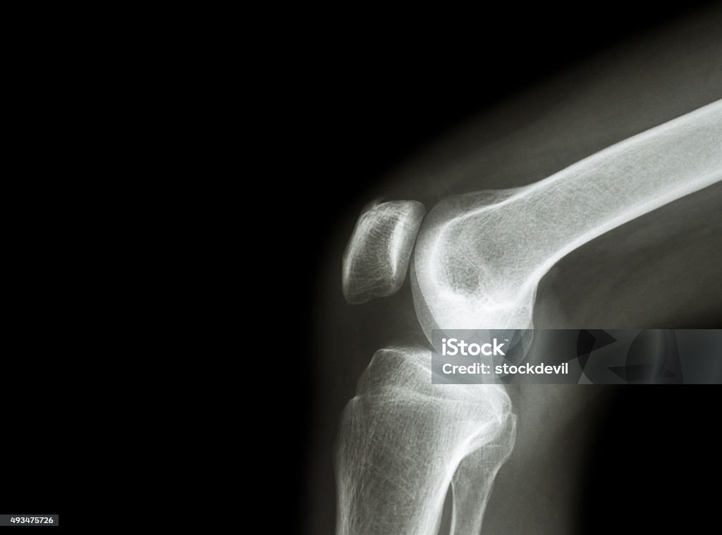 Film x-ray knee joint with arthritis Film x-ray knee joint with arthritis ( Gout , Rheumatoid arthritis , Septic arthritis , Osteoarthritis knee ) and blank area at left side Anatomy Stock Photo