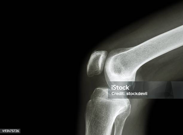 Film Xray Knee Joint With Arthritis Stock Photo - Download Image Now - Anatomy, Knee, Rheumatology