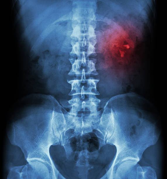 kidney stone (renal stone, renal calculi - haunch stock-fotos und bilder