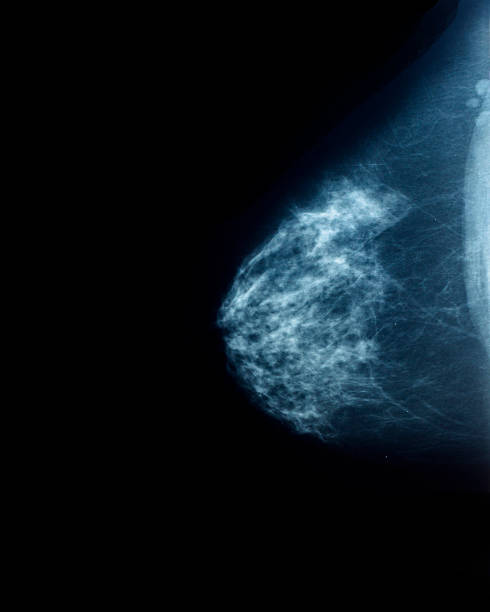 istock Mammography, medical examination. Profile view 493541198
