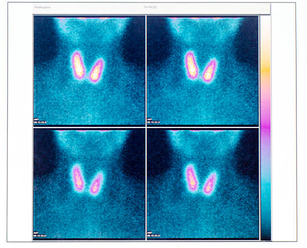 Scintigraphy of thyroid gland with two nodule Scintigraphy of thyroid gland with two nodule. Medical examination anamnesis stock pictures, royalty-free photos & images
