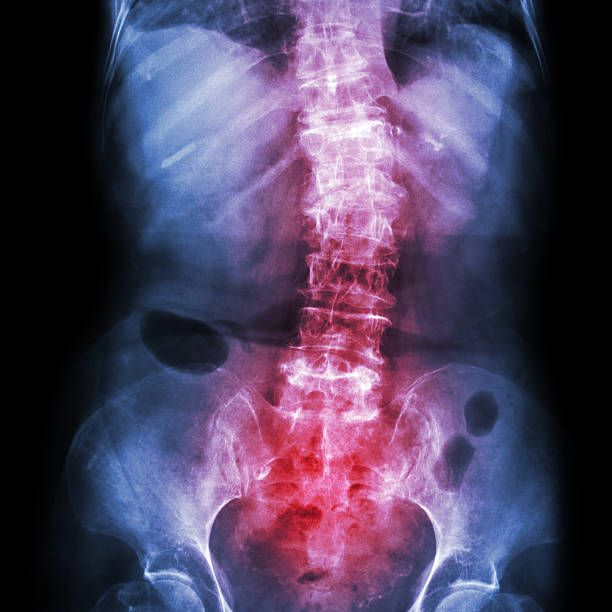 Spondylosis and Scoliosis Spondylosis and Scoliosis ( film x-ray lumbar - sacrum spine show crooked spine ) ( old patient ) ( Spine Healthcare ) animal spine stock pictures, royalty-free photos & images